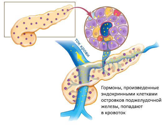Нейроэндокринная опухоль поджелудочной железы