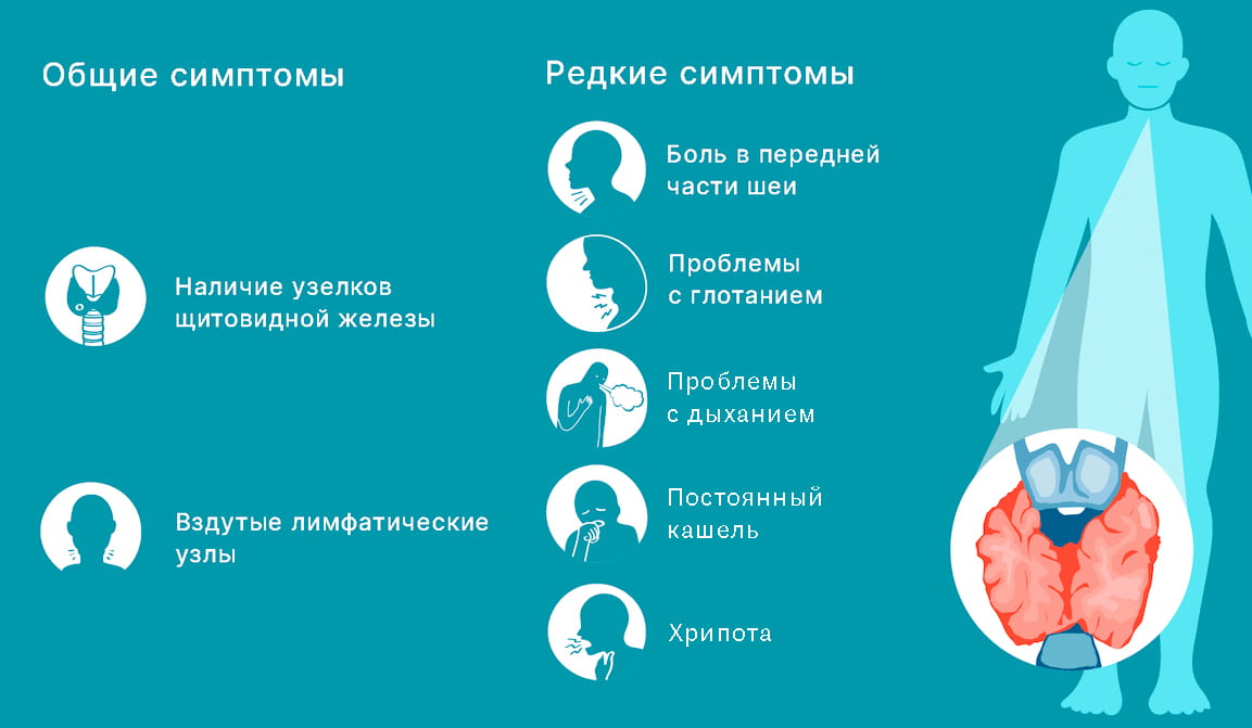 Симптомы рака щитовидной железы