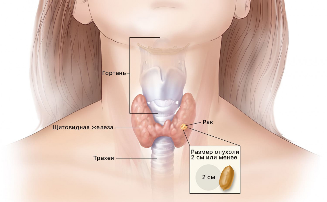 Первая (начальная) стадия рака щитовидной железы