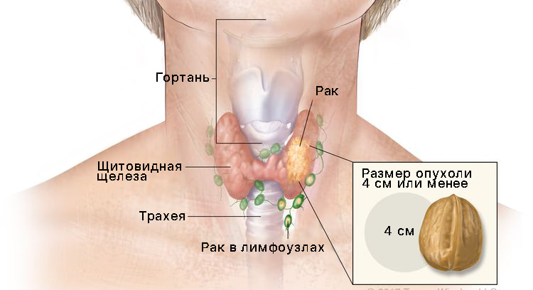 Вторая стадия рака щитовидной железы