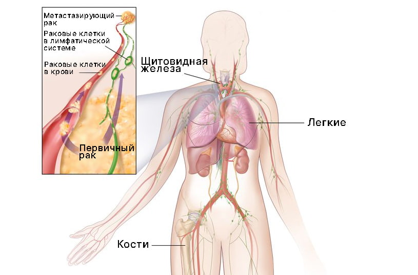 Третья стадия рака щитовидной железы