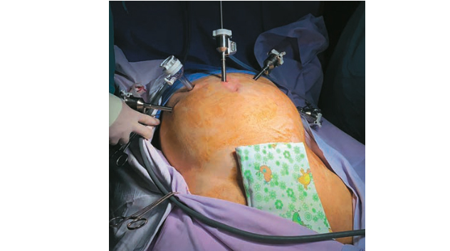 Рис. 3. Расположение троакаров (интраоперационая фо- тография). Fig. 3. Trocar arrangement. Intraoperative image.