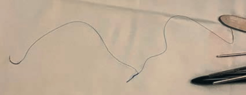 Рис. 6. Подготовленная нить prolene 5/0 (интраопераци- оная фотография). Fig. 6. Polypropylene 5/0 suture.