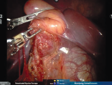 Рис. 3. Интраоперационная фотография кисты гепати- кохоледоха. Fig. 3. Intraoperative image of hepaticocholedochal cyst.