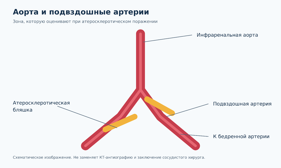 Атеросклероз аорты и подвздошных артерий
