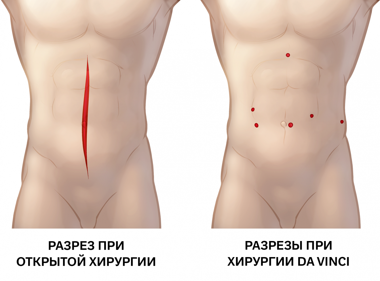 разрезы при робот-ассистированной фундопликации