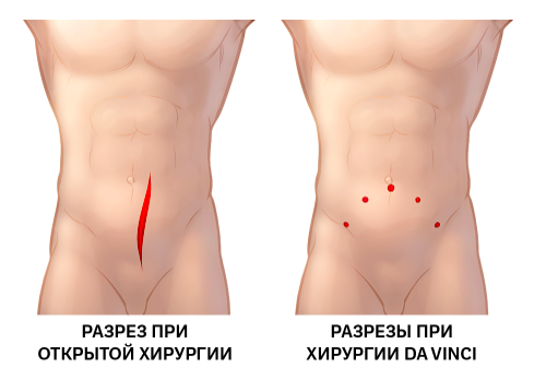 Разрез при открытой и робот-ассистированной операции