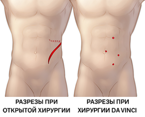 Разрез при открытой и робот-ассистированной операции