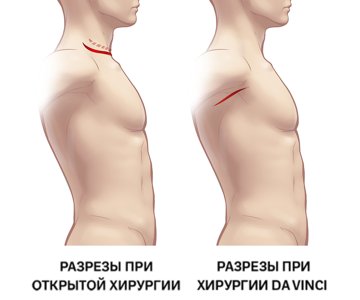 Хирургические разрезы при операции на щитовидной железе