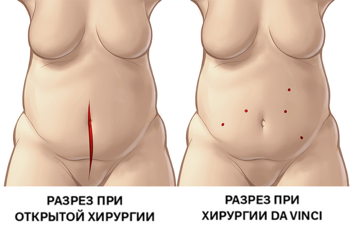 Рак эндометрия: разрез при полостной операции и робот-ассистированной операции da Vinci