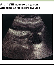 Возможность выполнения робот-ассистированной дивертикулэктомии