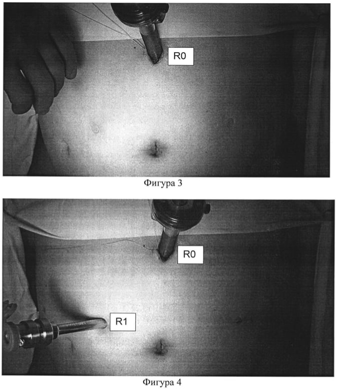 Фото: Установка троакаров при роботическойй операции