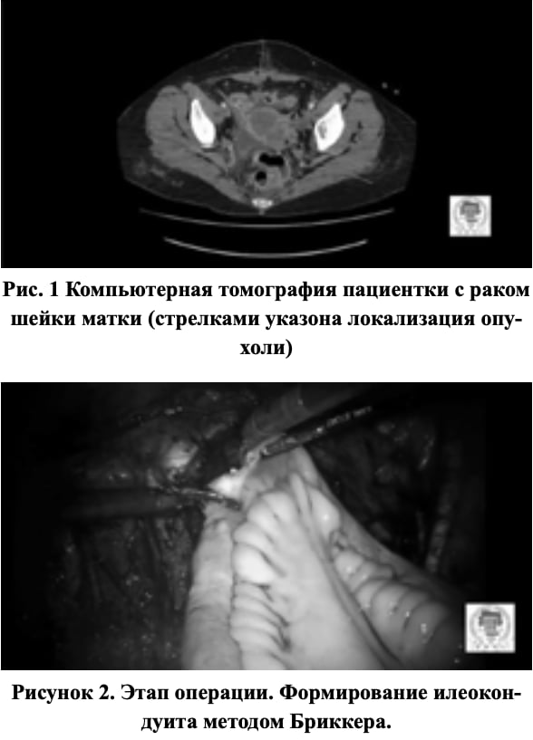 Копьютерная томография пациентки с раком шейки матки