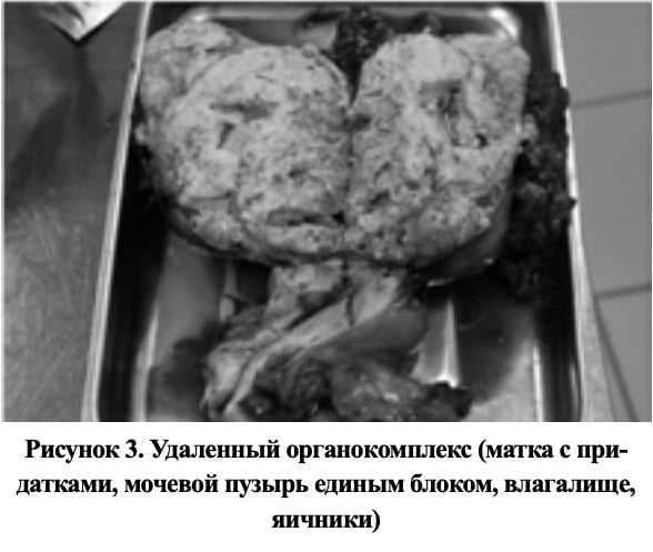 Удаленная матка с придатками