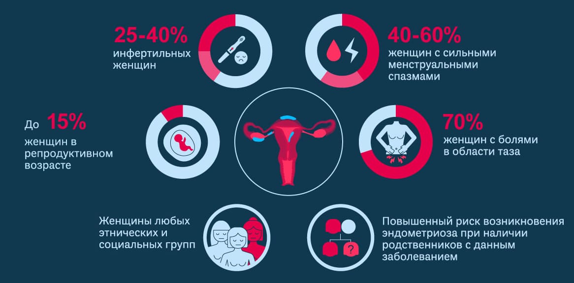 Об эндометриозе в инфографике