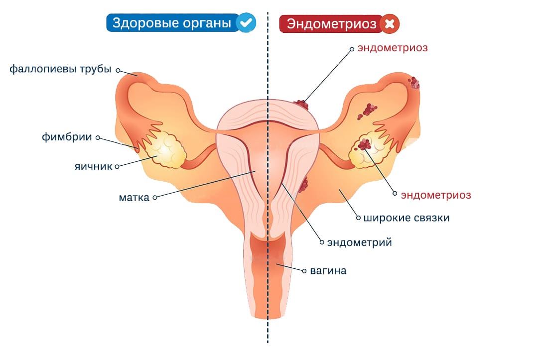 Сравнение органов с эндометриозом и здоровых органов