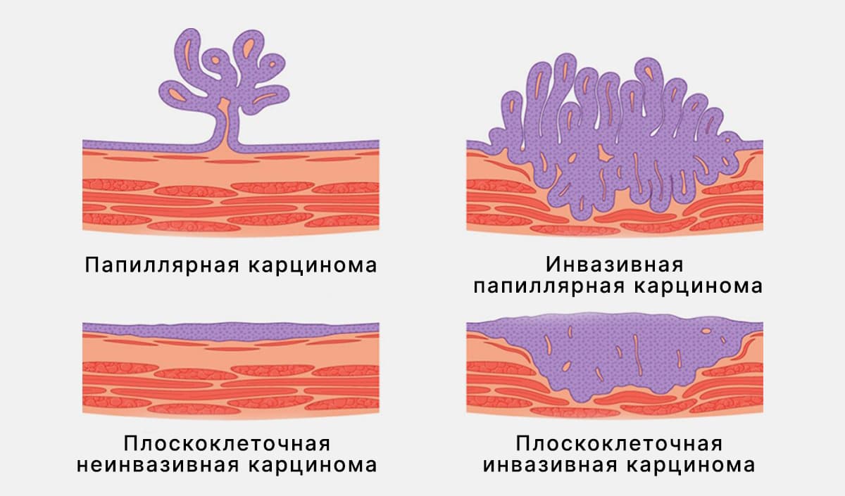 Виды рака мочевого пузыря