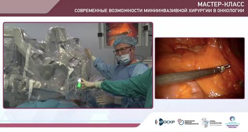Роботическая правосторонняя гемиколэктомия с D3 лимфодиссекцией и ICG навигацией